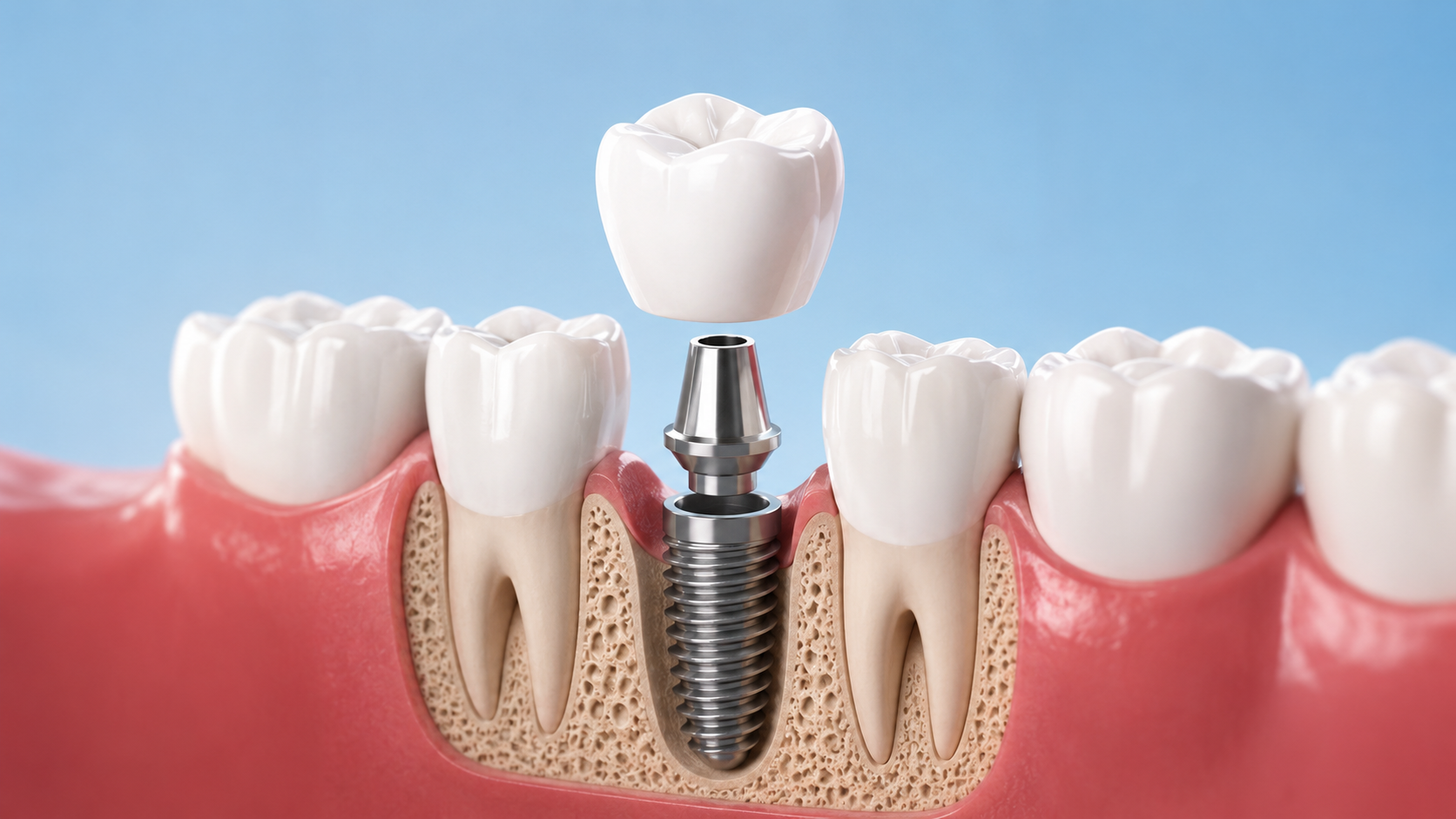 What Are Dental Implants